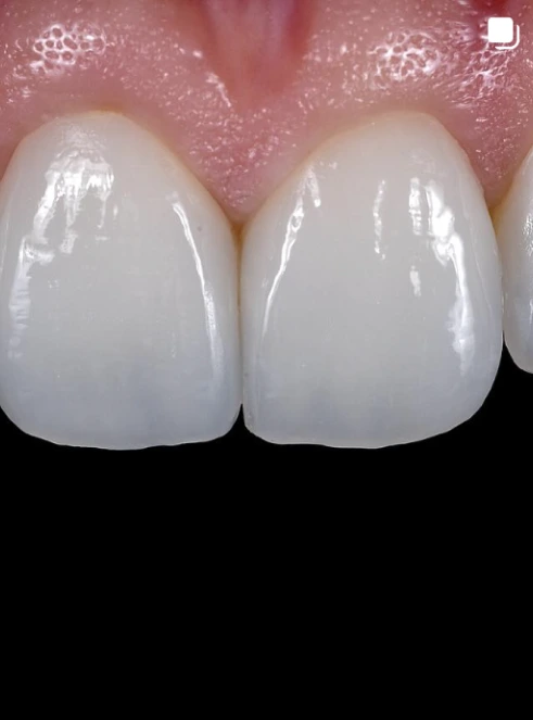 Detalhe de resultado estético dental natural