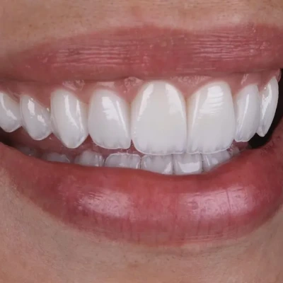 Sorriso natural após tratamento odontológico estético