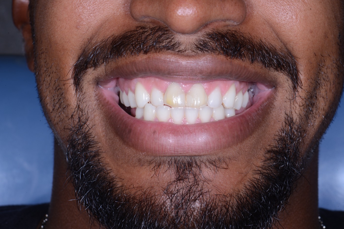 Condição inicial do sorriso do paciente Ricardo
