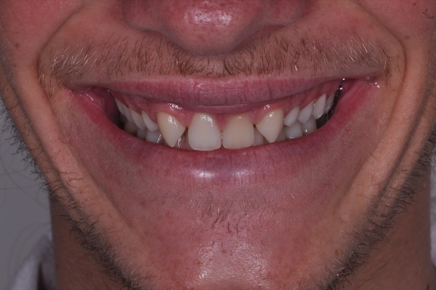 Condição inicial do sorriso do paciente Val