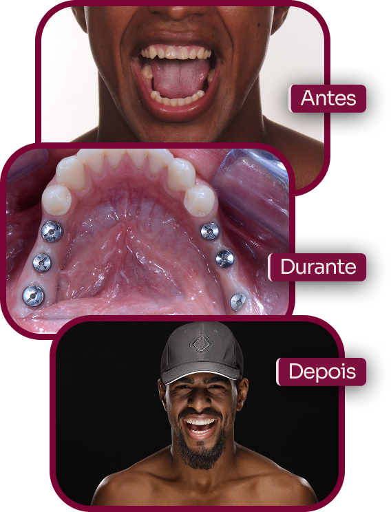 Etapas antes, durante e depois do tratamento com implantes dentários